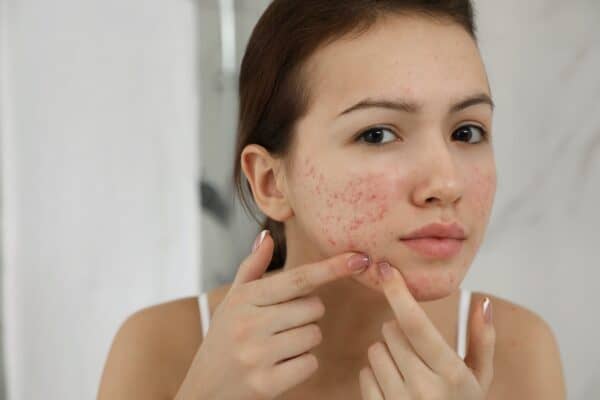 acne scars